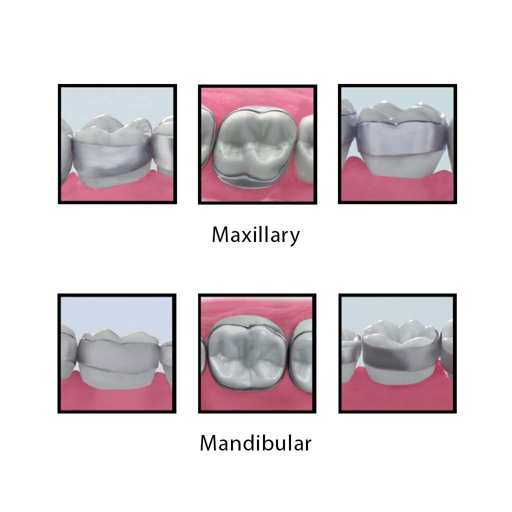 3M™ Victory Series™ Micro-etched Narrow 1st Molar Band Introduction Kit, Upper, 150 Pcs/Pack