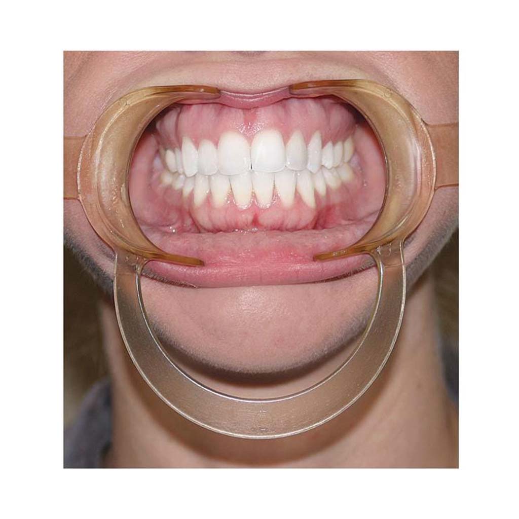 Ortho Technology Extraoral Cheek Retractor Autoclavable Pedo, Clear Each